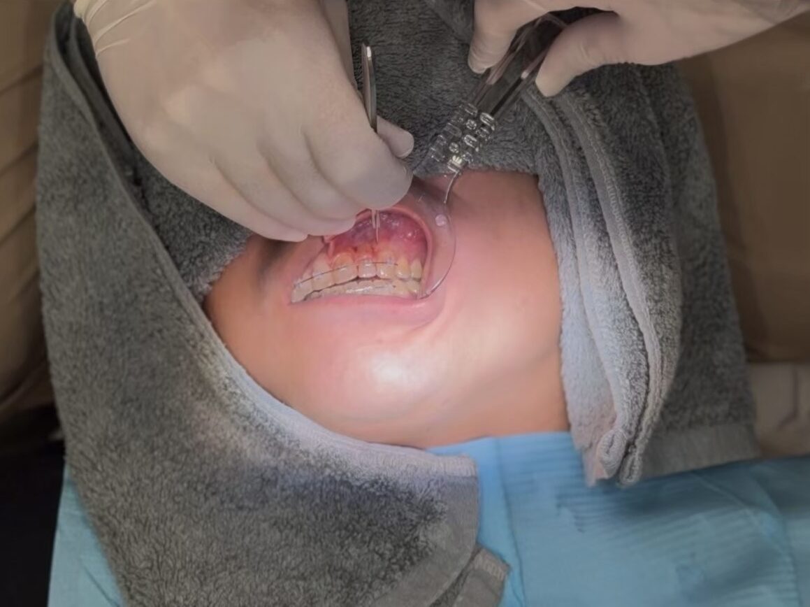 港区
矯正認定医
外科処置