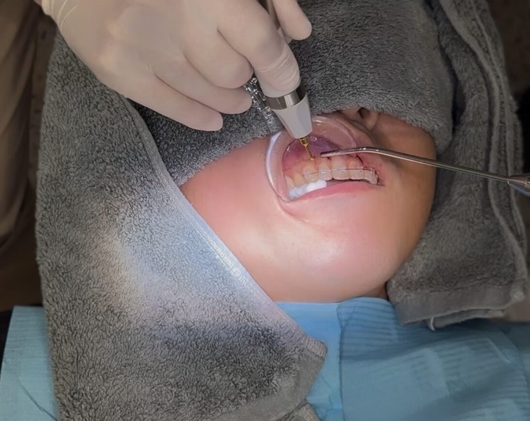 ピエゾシジョン
外科処置
早く矯正治療終わらせたい