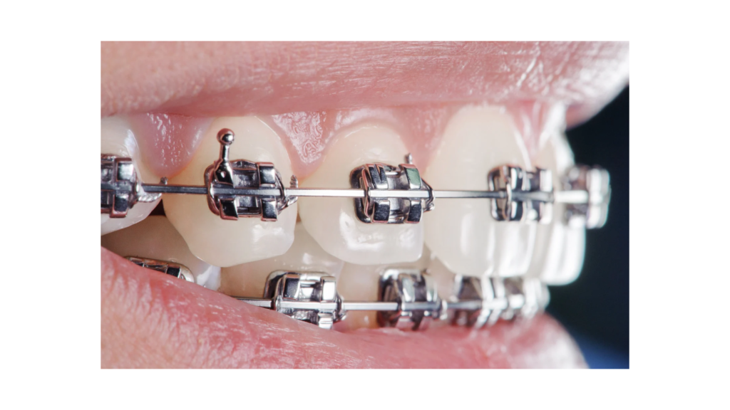 ワイヤー矯正 品川 港区 矯正 矯正専門
マウスピース矯正