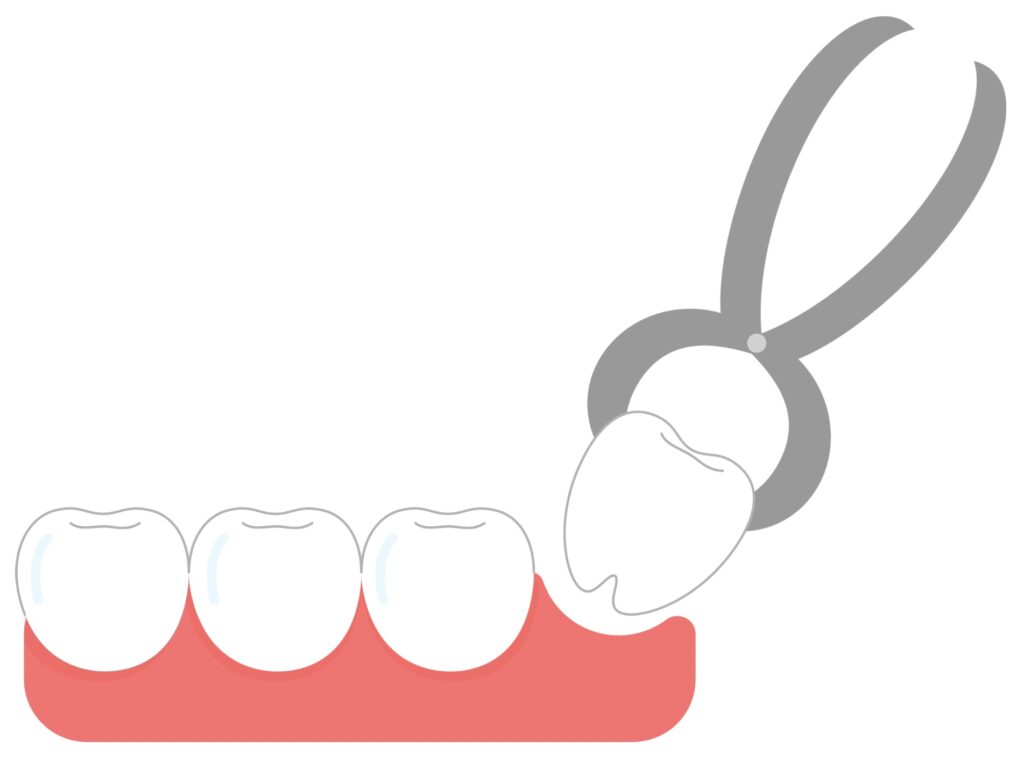 抜歯 抜歯矯正 ドライソケット 親知らず抜歯 親知らず