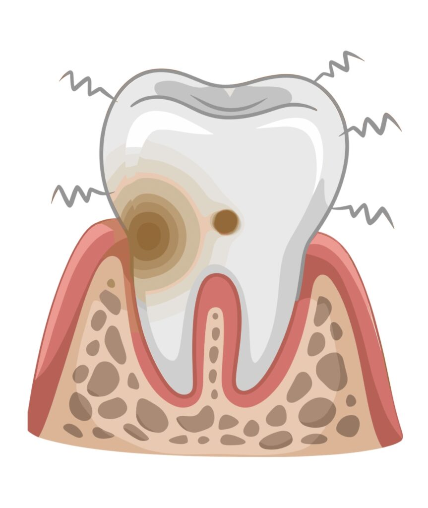 歯の着色
虫歯
歯の色
エアフロー