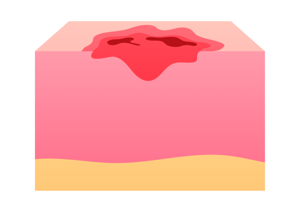 かさぶた
血餅
ドライソケット
抜歯