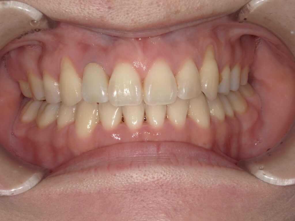 噛み合わせ 歯並び ガタガタ