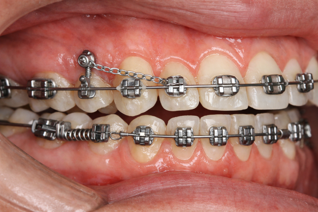 矯正用アンカースクリュー 歯列矯正 矯正用ネジ 品川矯正歯科
TAD