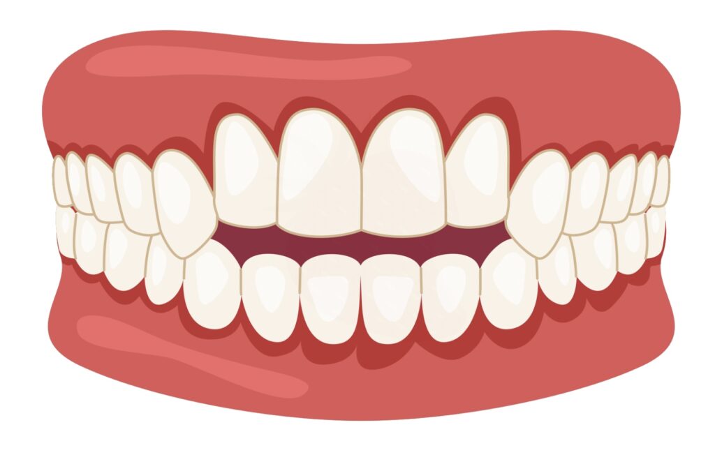 開咬 噛めない
前歯噛んでない