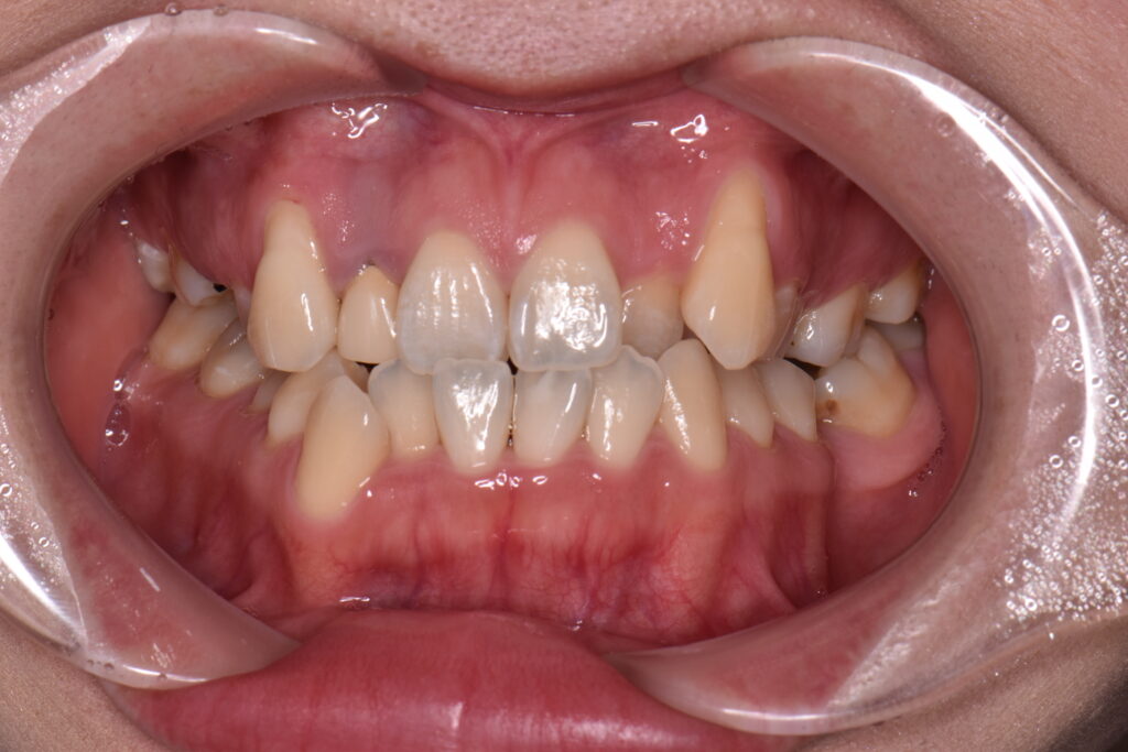 叢生
歯並びガタガタ
噛み合わせ
矯正
歯列矯正