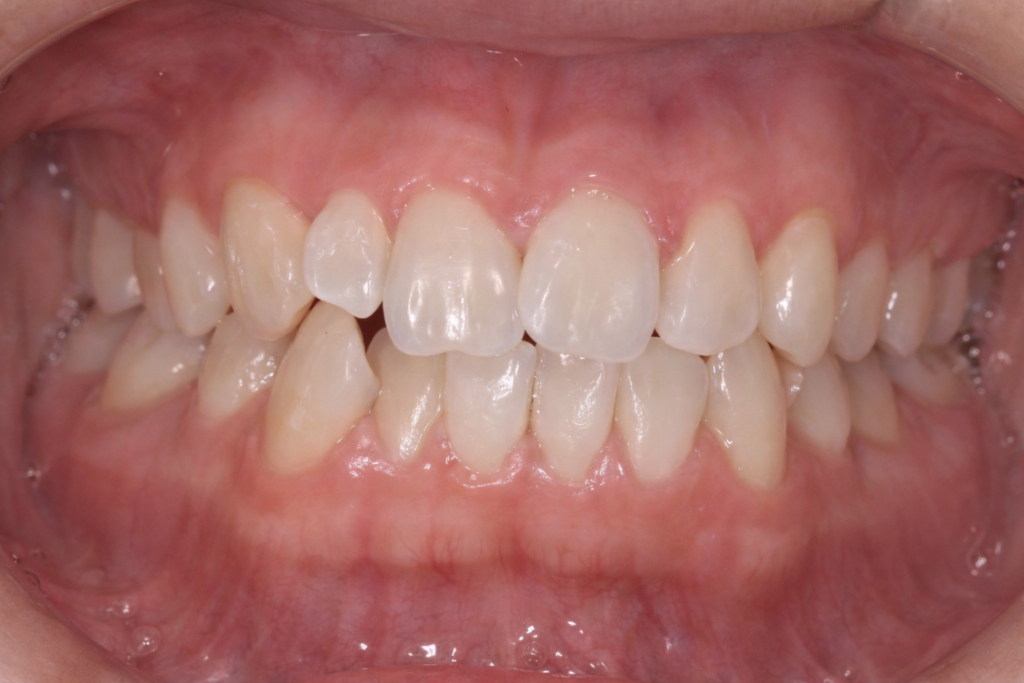 歯並び ガタガタ 叢生 歯の捻れ