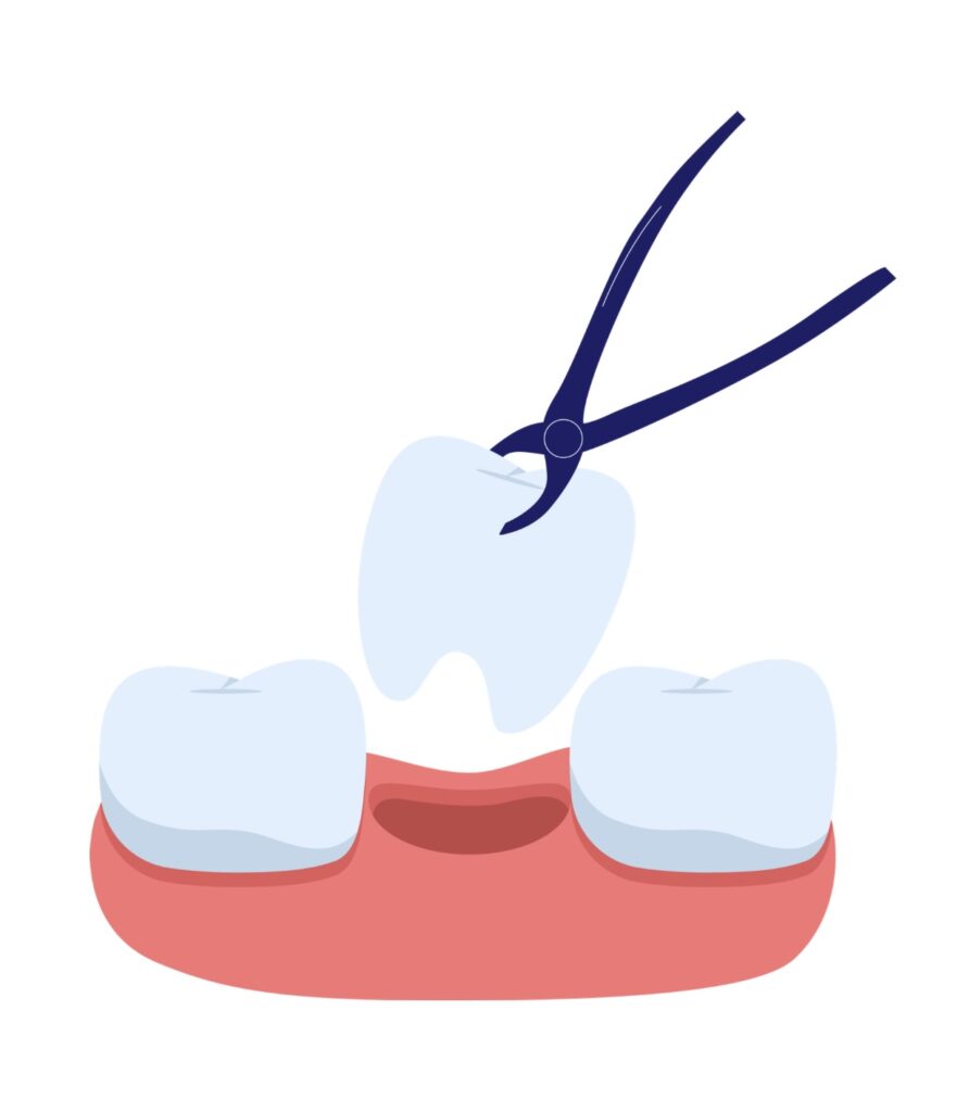 抜歯矯正
抜歯
歯を抜く
矯正
便宜抜歯